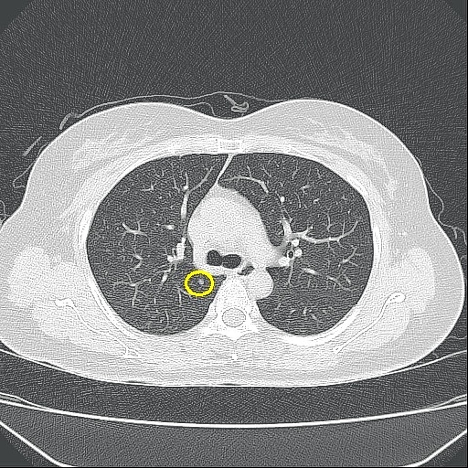 폐결절 환자의 CT 검사 결과 사진. 동강병원 제공
