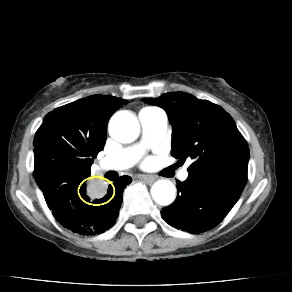 폐암 환자의 CT 검사 결과 사진. 동강병원 제공